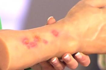Kako prepoznati alergije na piki komarjev?