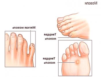 Сортове царевица на пръстите на краката и методи за борба с тях