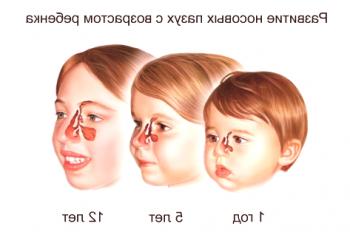 Angina de pecho en el niño: síntomas y tratamiento, causas de aparición.