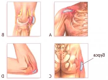 Quemadura de la articulación de la rodilla, sus signos y el curso de la enfermedad.