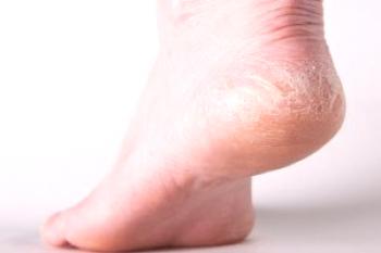 Vzroki za lupljenje kože na stopalih in pravila za nego stopal