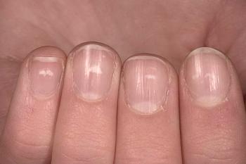 Las razones de la aparición de manchas y rayas blancas en las uñas y cómo deshacerse de ellas.