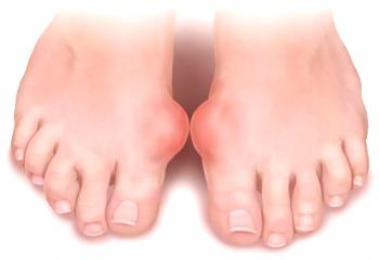Protin na nogah: vzroki, simptomi in zdravljenje