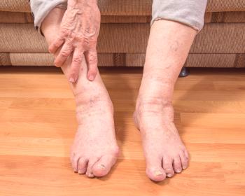 Starostne spremembe ali drugi razlogi: zakaj so noge starejše ženske otekle?