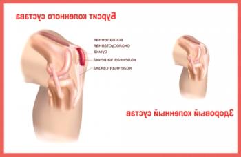 Tratamiento de la bursitis suprapatial de la articulación de la rodilla.