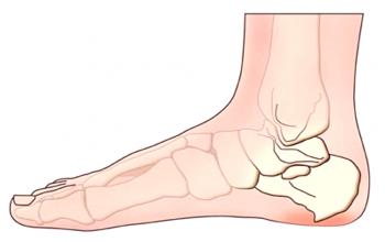 Kosti in Ahile na nogah: kako jih zdraviti?