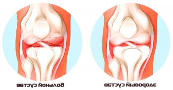 Simptomi in vzroki artroze kolenskega sklepa