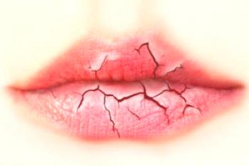 Zakaj se suha in razpokana ustnica: 3 razlogov in 5 načinov zdravljenja