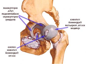 Tratamiento y consecuencias de la necrosis de la cadera de la articulación de la cadera.