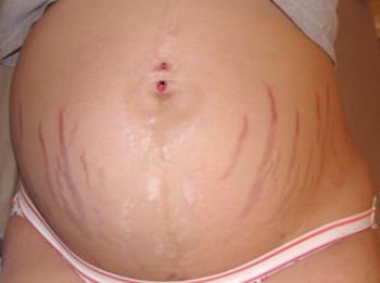 Stretch pri nosečnicah: kako preprečiti in kako se znebiti