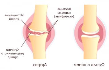 Desarrollo y tratamiento de la artrosis de las extremidades inferiores.