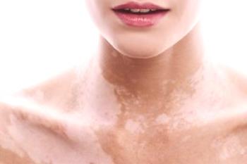Cómo deshacerse de las manchas pigmentarias en la cara y el cuerpo - remedios caseros y populares + prevención