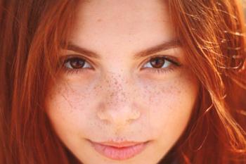 Manchas pigmentadas en la cara: las causas de su apariencia, tipos y métodos de tratamiento