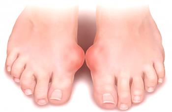 Causas y métodos de tratamiento de la bursitis del pie.
