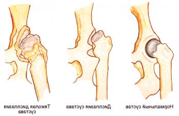 Detalles sobre la displasia de las articulaciones de la cadera.
