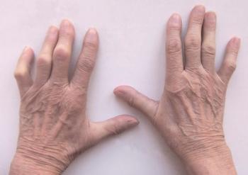 Artrosis de los dedos: causas, tratamiento y prevención.