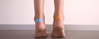 Видове мазоли на краката и тяхното лечение
