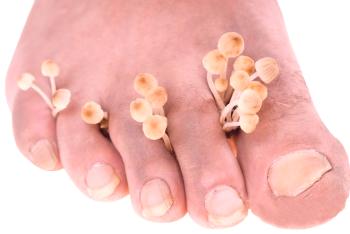 Síntomas y tratamiento de hongos en las uñas de manos y pies. Remedios efectivos para las uñas de hongos.