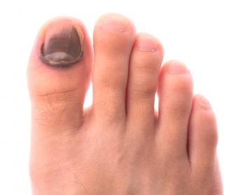 Por alguna razón, el clavo en el dedo gordo del pie se oscurece: ¿qué hacer?