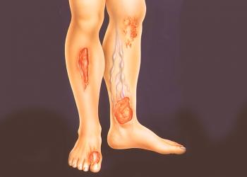 Causas y tratamiento necesario de las úlceras en las piernas.