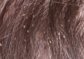 Научете как да се отървете от гниди на дълга коса