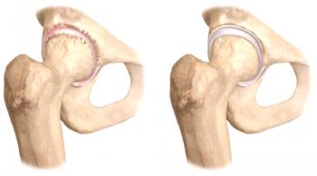 Osteoporosis de la articulación de la cadera: síntomas, tratamiento