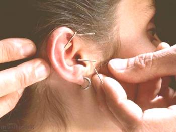 Akupunktura ušesa kot sredstvo za izgubo telesne teže