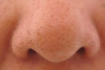 ¿Cómo eliminar los puntos negros de la nariz en casa?