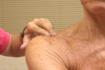 Bursitis de la articulación del hombro: inflamación del líquido articular.