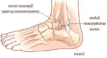 Signos y tratamiento de un ligamento extensible de la articulación del tobillo.