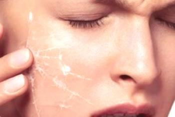 Kaj storiti, če se koža lušči na obrazu? Medicinske in salonske metode boja + 4 ljudske recepte