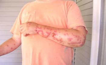 Kaj je posledica alergije na stenice in ali je mogoče zdraviti?