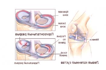 Diagnoza in zdravljenje meniskusa kolenskega sklepa