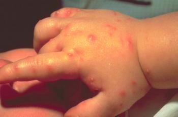 Kaj ugušiti ugriz komarjev za majhnega otroka