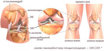 Causas y síntomas de inestabilidad articular de la rodilla.