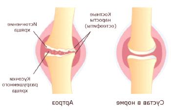 Vzroki in zdravljenje artroze kolenskega sklepa
