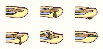 Cuando el dedo del pie se colapsa cerca de la uña: causas y cura