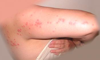 Alergija na ugriz žuželke.Kako ga prepoznati in se znebiti?