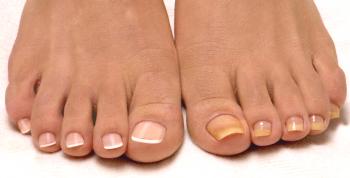 Causas de las uñas amarillas en las piernas.