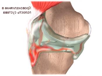 Какво е хемартроза на колянната става: симптоми и лечение