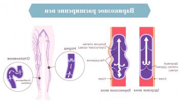 Krčne žile: Kaj povzroča širjenje žil na nogah