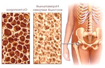 Osteoporosis: características de la destrucción del tejido óseo.