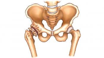 Consecuencias y tratamiento de la osteoartritis de la articulación de la cadera.