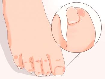 Kako določiti goji noht na nogi in kaj narediti