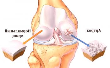 El papel de la fisioterapia en la artrosis de la articulación de la rodilla.