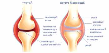 Síntomas de artritis de la articulación de la rodilla y métodos de tratamiento.