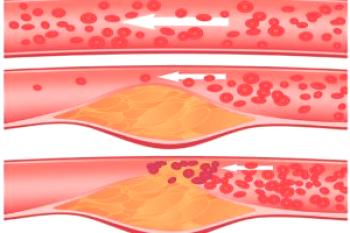 Aterosclerosis de las arterias braquiocefálicas: ¿qué es?