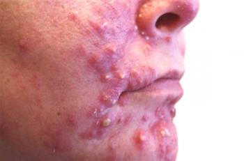 Síntomas y tratamiento del ácaro subcutáneo en la cara.