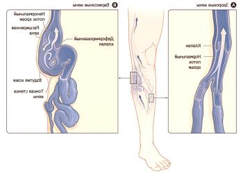 Remoción de varices en las piernas mediante cirugía.