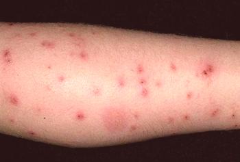 Picaduras de pulgas de una persona: síntomas y tratamiento.
